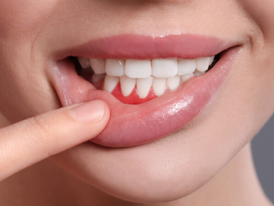 Gum Surgery